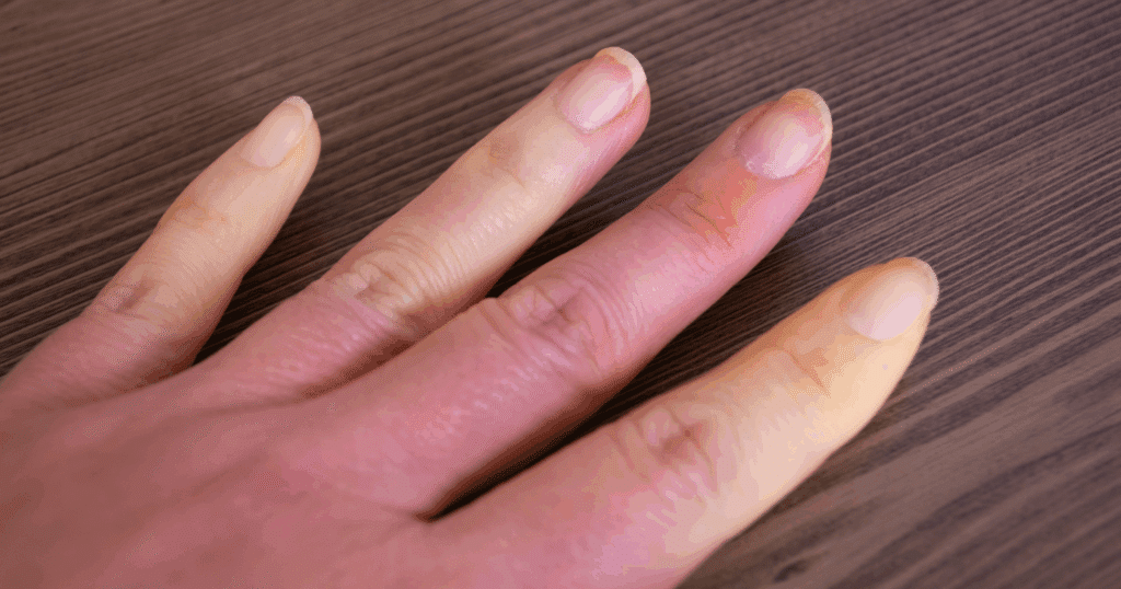 acupuncture-for-raynaud’s-syndrome-a-gentle-approach-to-numbness-tingling-and-cold-sensitivity
