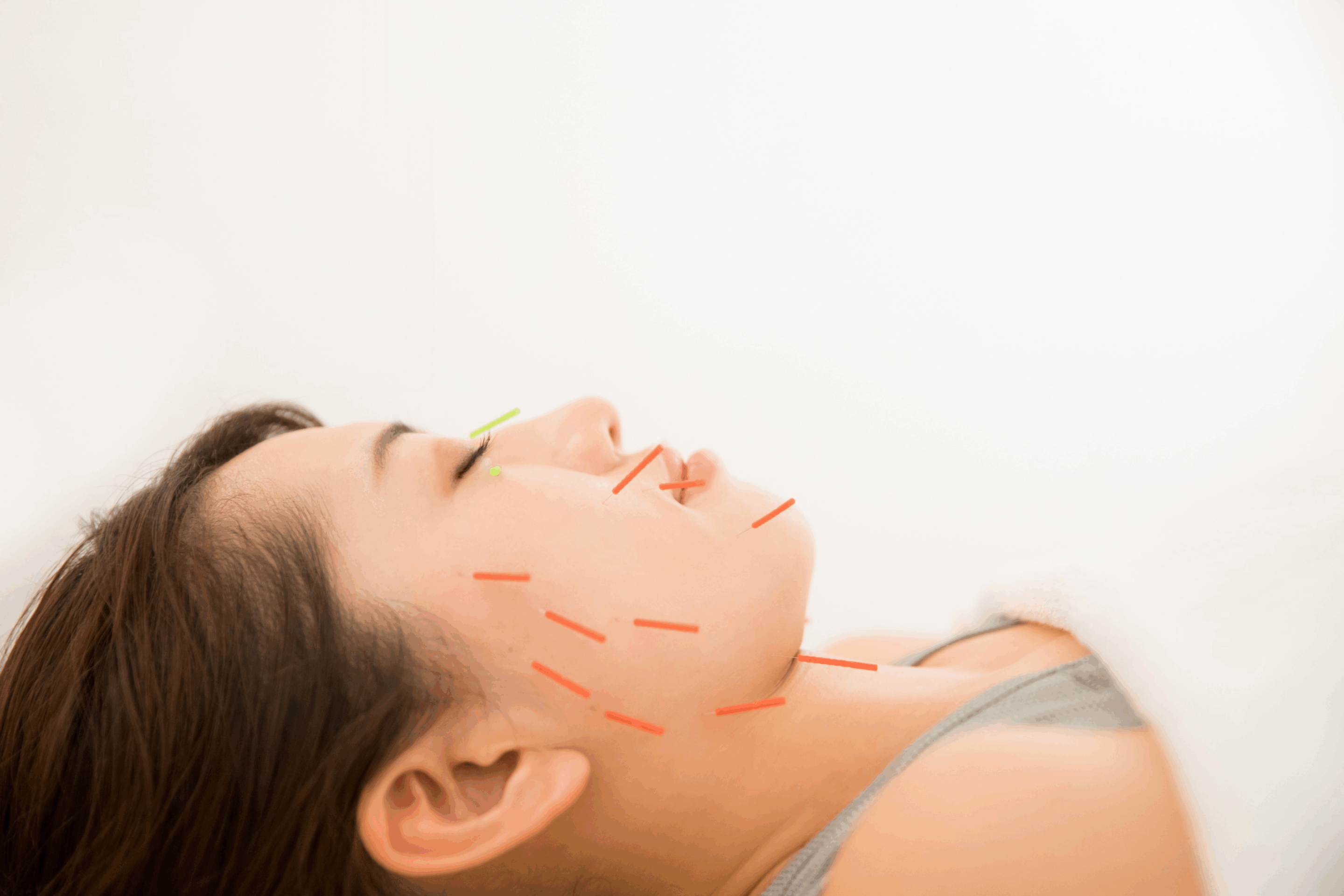 Before Acu Facial Treatment