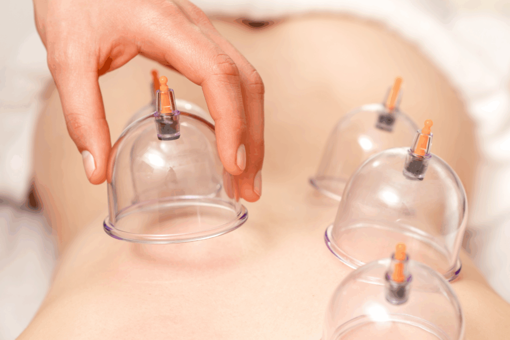 Cupping Therapy