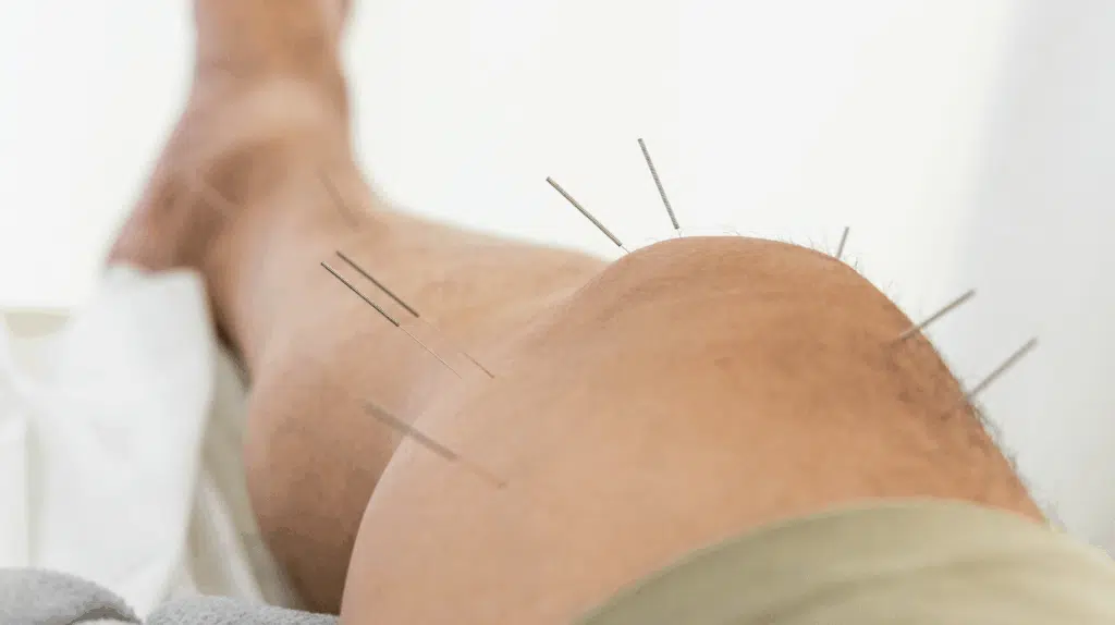 Does Acupuncture Really Work for Hamstring Strain