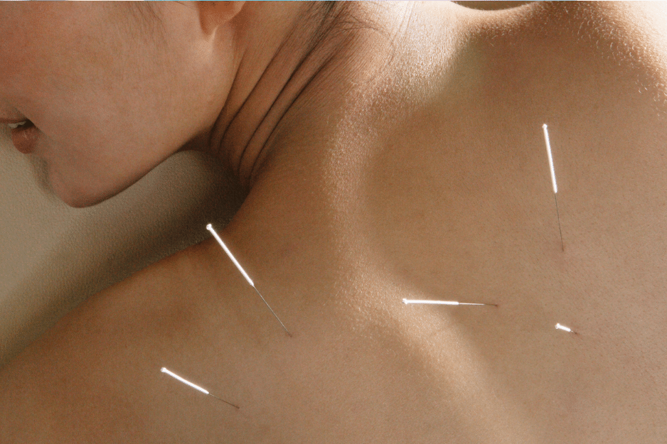 How Acupuncture Helps Fibromyalgia Pain