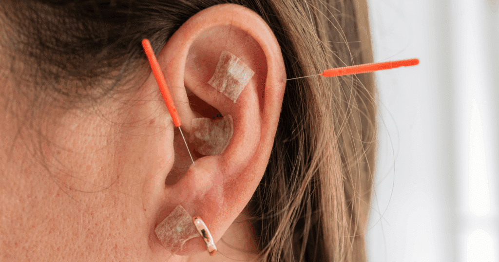 Integrating Ear Seeds Into a Comprehensive Migraine Plan