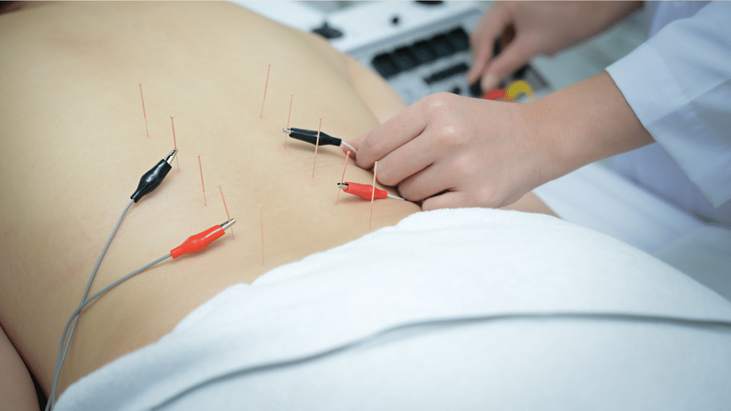 Acupuncture treatment used as a natural therapy to relieve restless leg syndrome symptoms and improve nerve regulation.