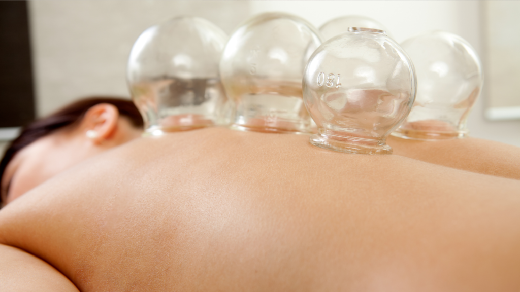 Cupping therapy applied to the upper back and shoulder area to support pain relief and muscle tension release