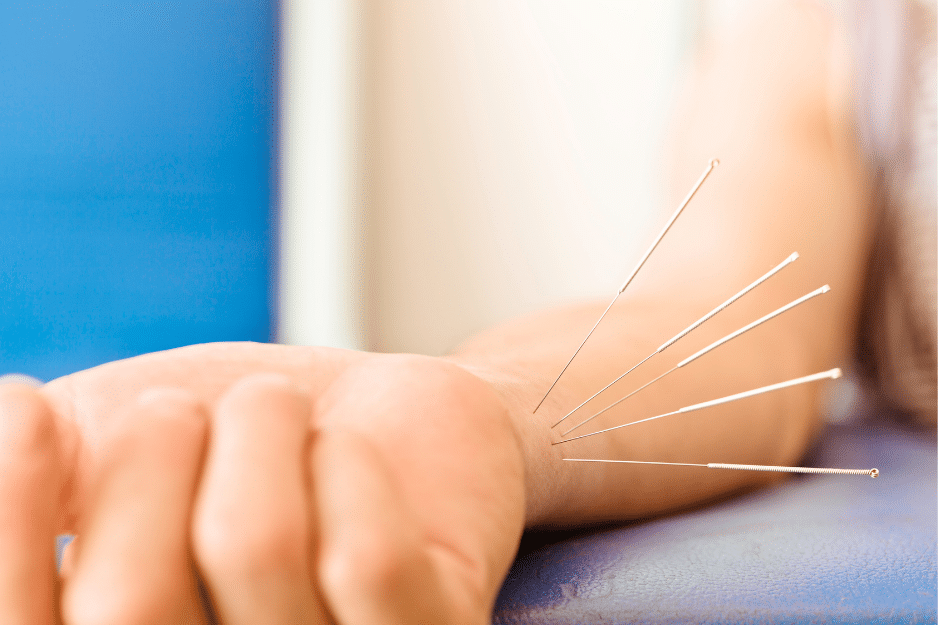 How acupuncture helps you quit smoking