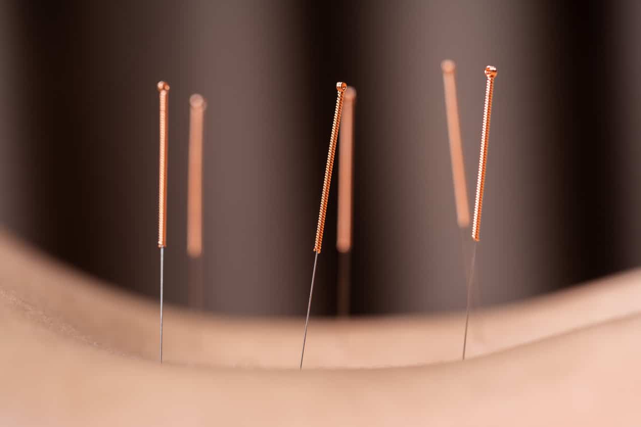 Close-Up Of Acupuncture Needles On Skin ACA Acupuncture and Wellness