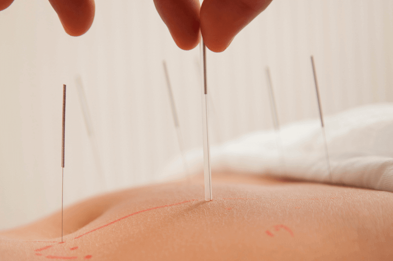 How Deep Do Acupuncture Needles Go Depth Anatomy Patient Safety 