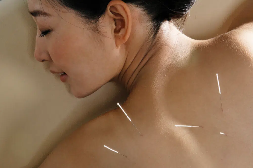 Acupuncture needles placed on upper back for muscle tension and pain relief therapy