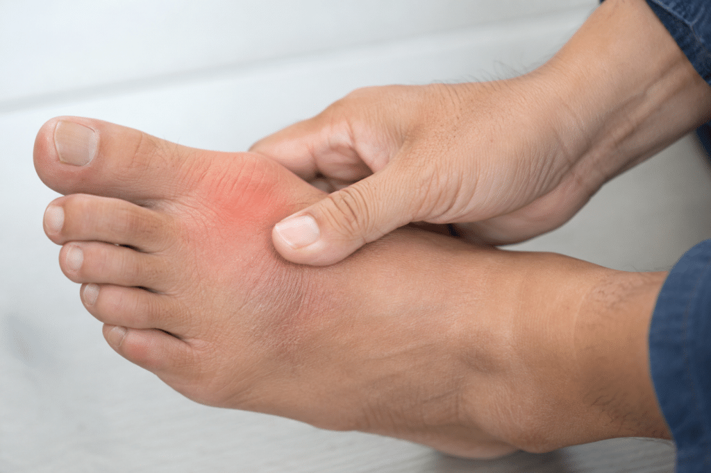Close-up of a painful big toe joint with redness and swelling from a possible gout flare-up