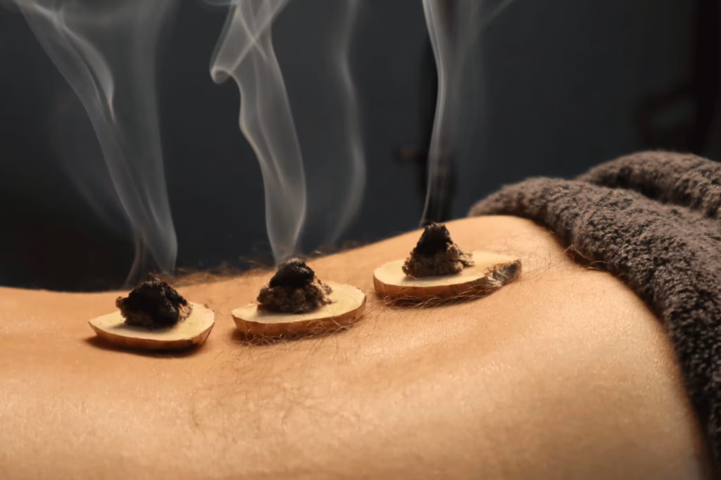 Moxibustion treatment with smoking moxa placed on ginger slices along a patient’s back