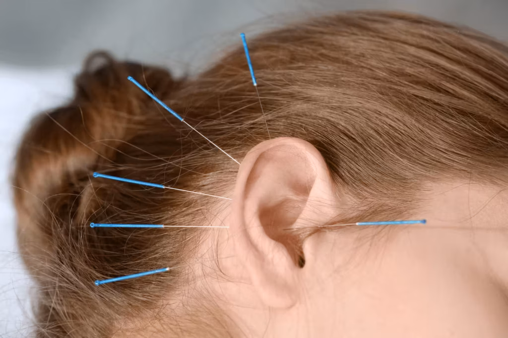 Acupuncture needles placed around the ear to support tinnitus and ear-related symptoms