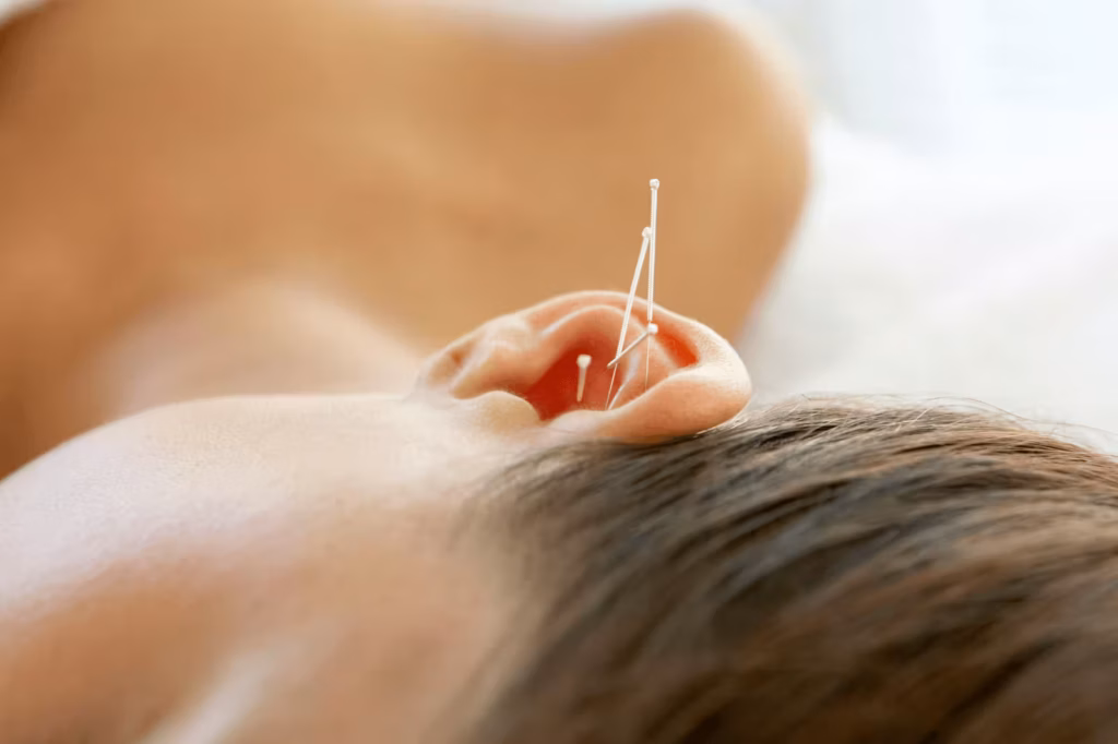 Close-up of acupuncture needles placed on the ear during tinnitus support treatment